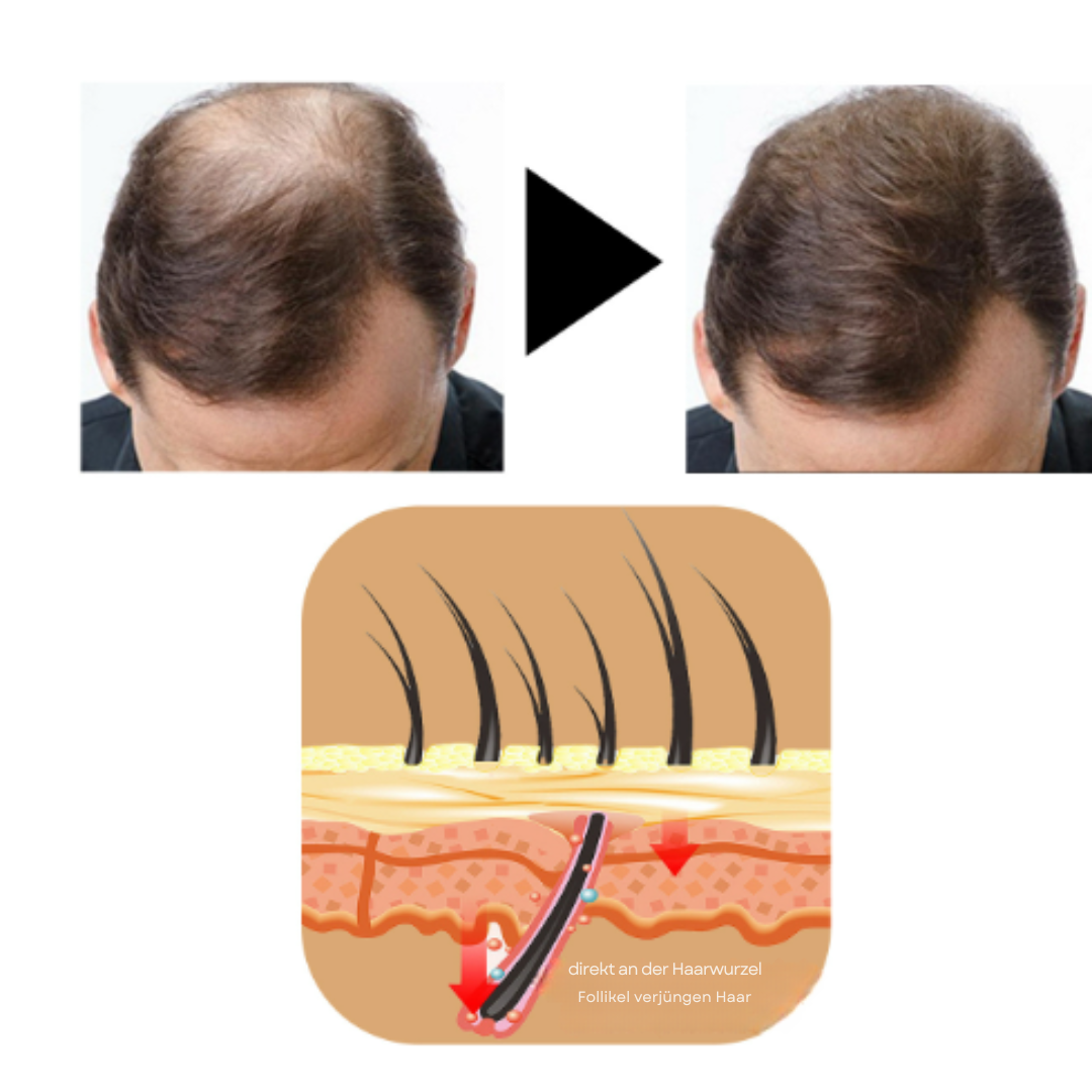 HairFix™ | Ikke flere skallede flekker!